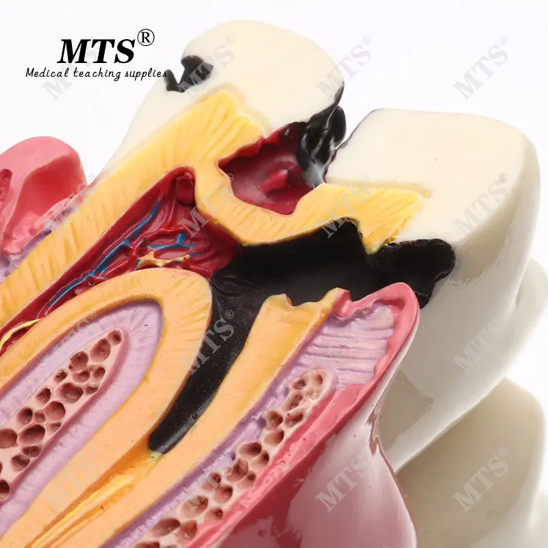 6 кратная модель зубного протеза MTS Молярная Модель контраста зубной кариес