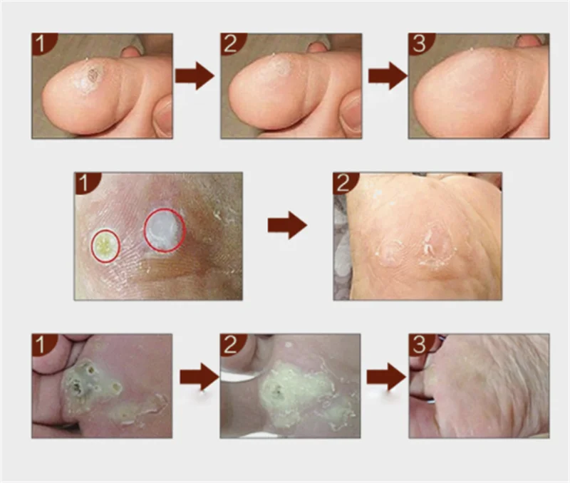 40 шт мозоли для ног подошвенные бородавки шип обезболивающий пластырь