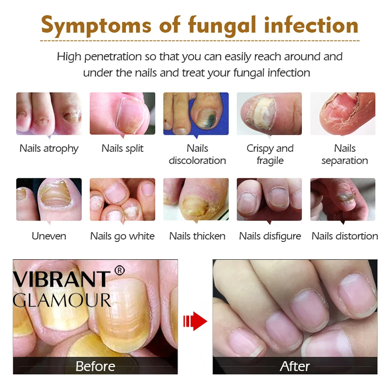 Vibrantglamur травяные Антибактериальные Средства для ухода за ногтями жидкий экстракт грибка для ногтей ремонт уход за ногтями на ногах улучшение инфекции TSLM1