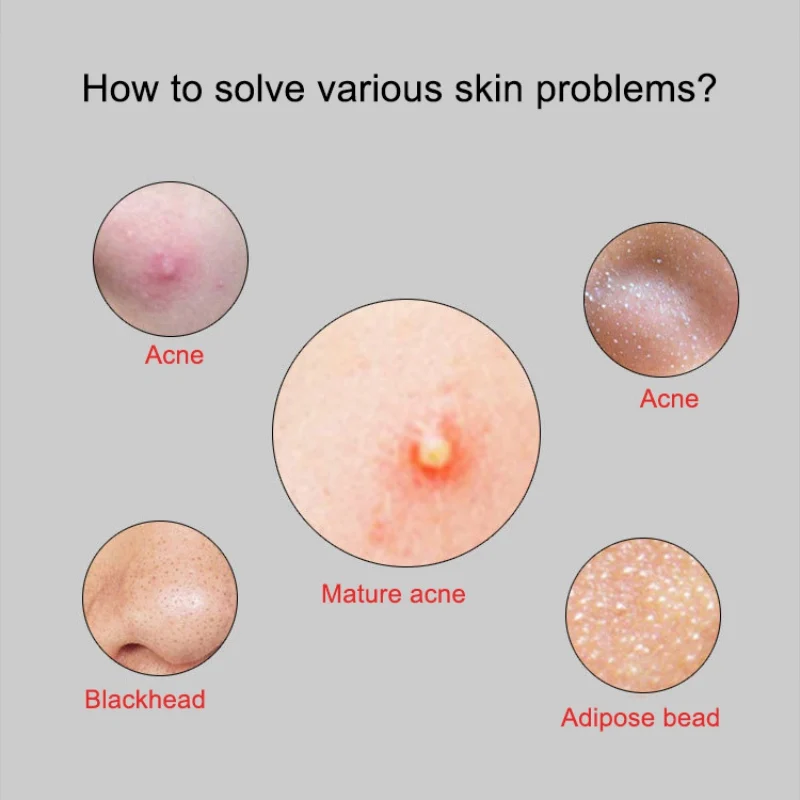 7 шт. набор инструментов для удаления чёрных точек на лице | Красота и здоровье