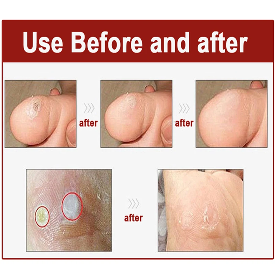 80 шт. наклейка на мозоли для ног отшелушивающая пластырь мягкая удаления