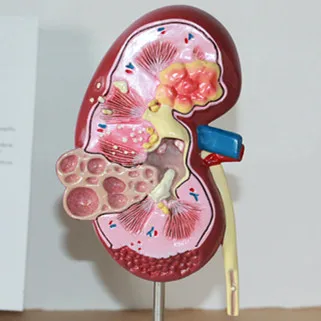 Медицинская модель развившейся почки с раком человека