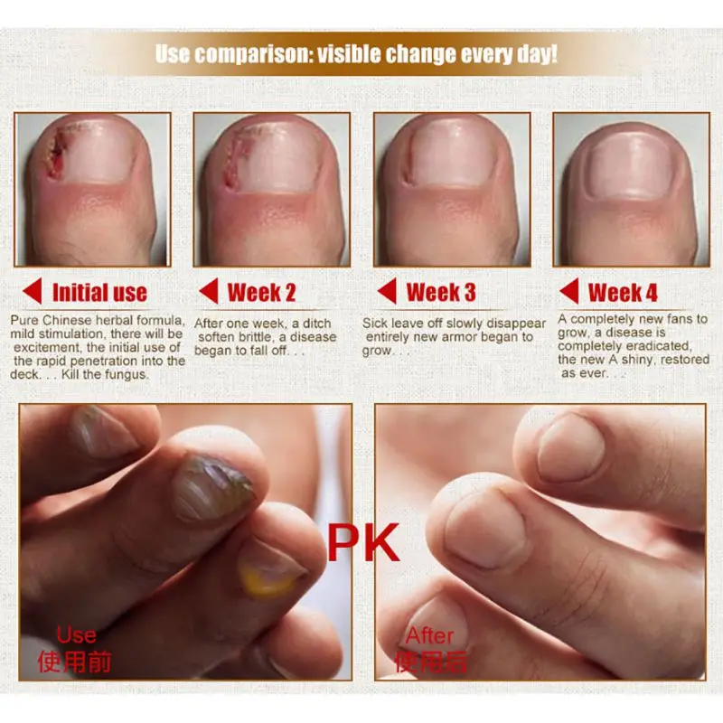 Горячая 30 мл гель для ухода за ногтями грибковое Лечение ногтей эссенция