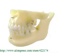 Free Shipping Implant model with orthodontics dental tooth teeth dentist anatomical anatomy odontologia | Канцтовары для офиса и