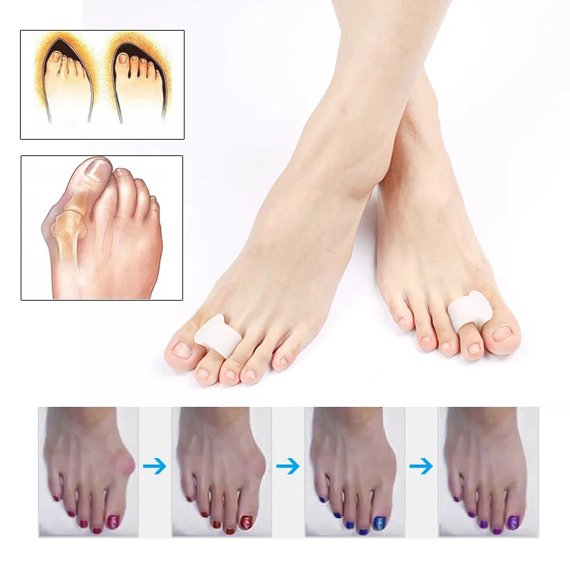 50 пар Силиконовые Бурсит большого пальца стопы Корректор выпрямитель гель