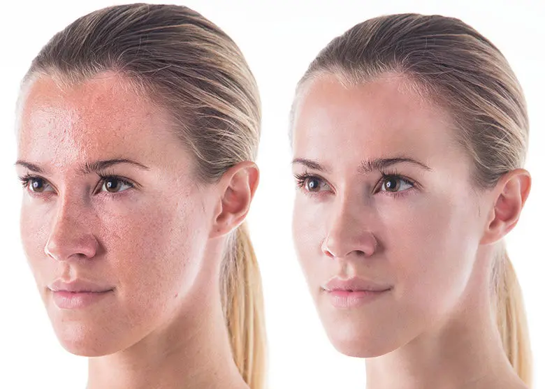 Гликолевая кислота 30% Восстанавливающий пилинг отшелушиватель чистый AHA