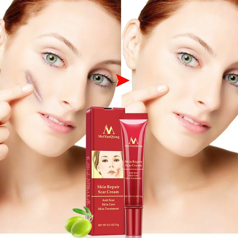 Acne Scar Removal Cream Skin Repair Face Spots Treatment Blackhead Whitening Anti Stretch Marks Hot! | Красота и здоровье