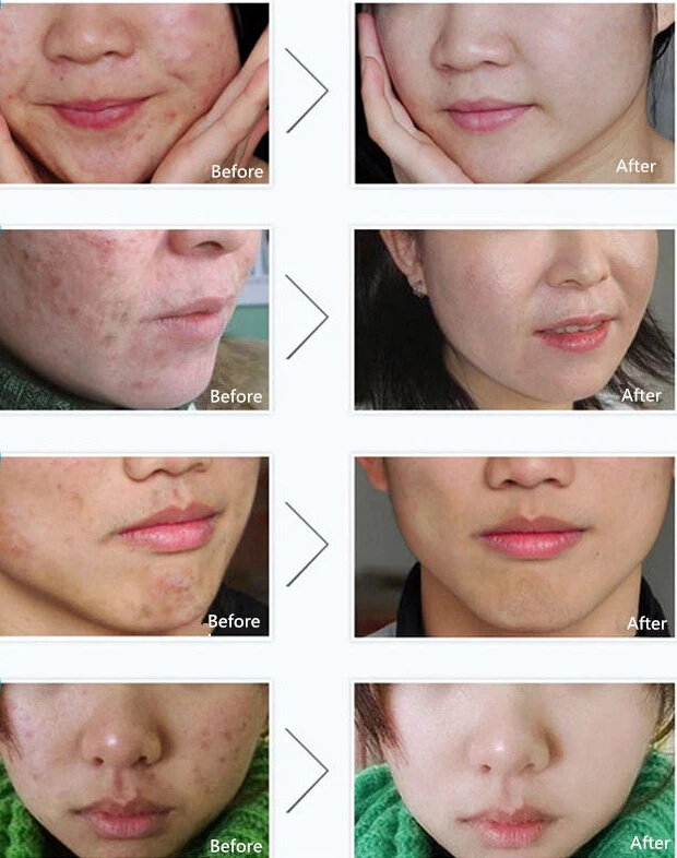 BIOAQUA марки Acne крем анти-акне удаления отбеливающий гель увлажняющий крем для лица 30 г масла Contorl уход за кожей