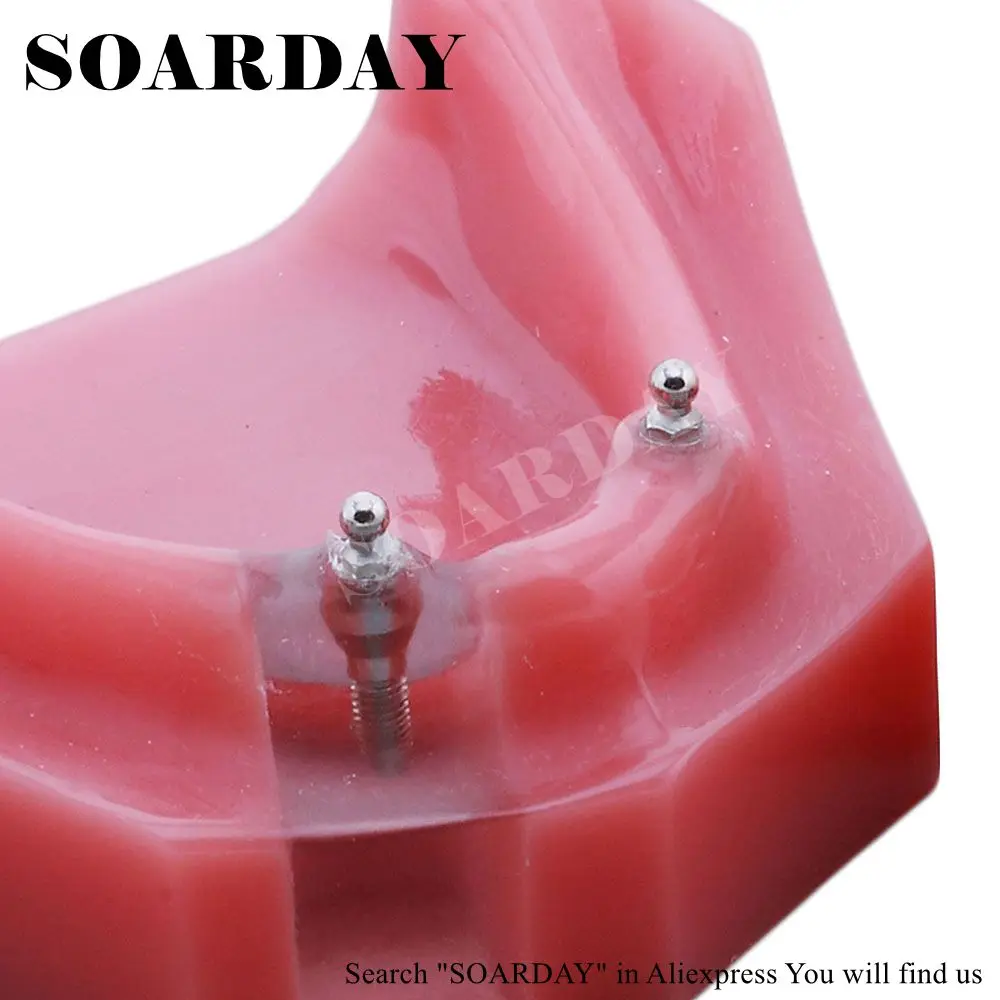 SOARDAY Overdenture нижняя с 2 имплантатами стоматологический зуб стоматолог