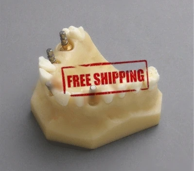 Бесплатная доставка модель импланта стоматологический зуб стоматолог