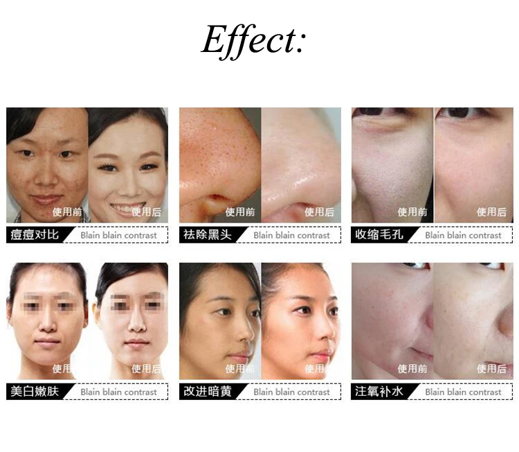 6 зондов маленький косметический инструмент 5 в 1 прибор для управления кожей