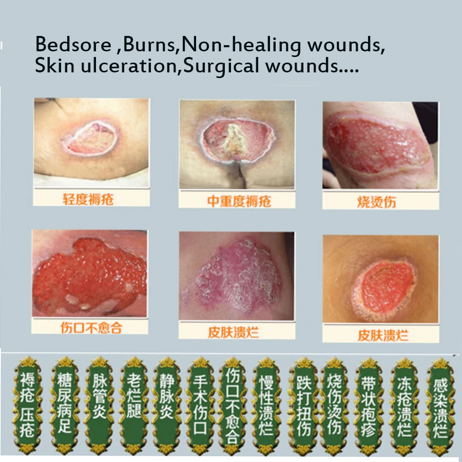 2 шт. травяная паста для удаления геля миогенная пролежней лечения декубитов под