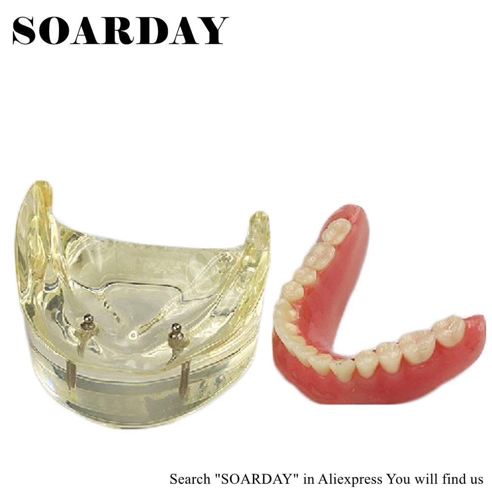 

SOARDAY Dental Lower Removable Overdenture Inferior with 2 implants Demonstration Teeth Anatomy Pathology Dentistry Tooth Model