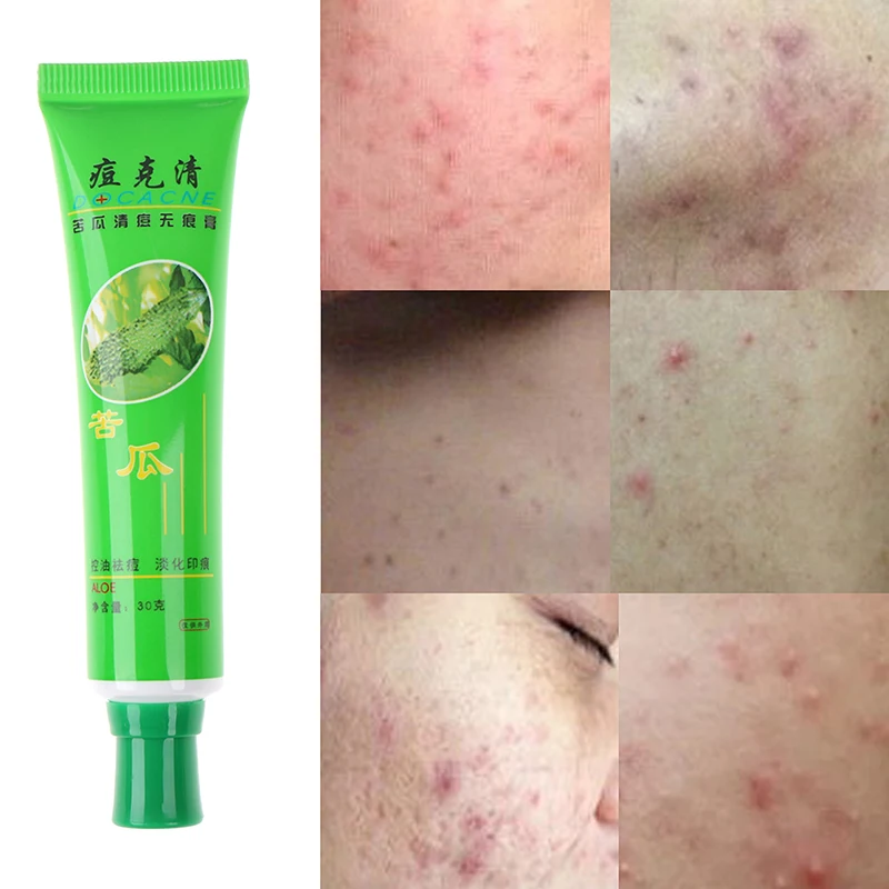 Натуральный гель против морщин с алоэ вера удаление Увлажняющий анти акне