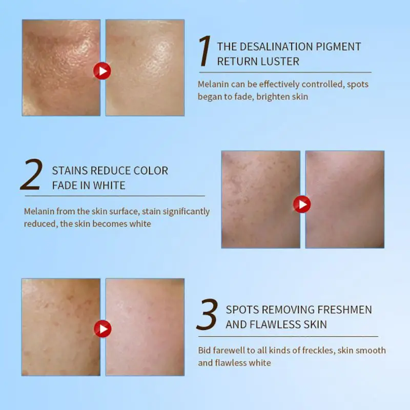 Новый лечебный пигмент отбеливающий увлажняющий крем веснушки уход против