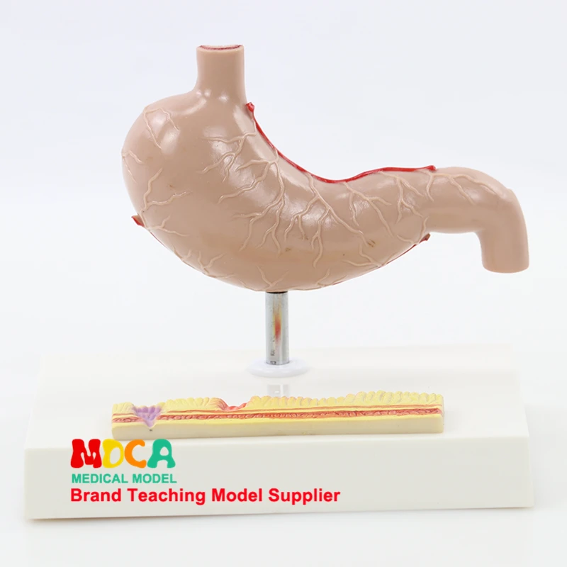 Pathological gastrointestinal model human gastric lesions teaching aids digestive system medicine MCW008 | Канцтовары для офиса и