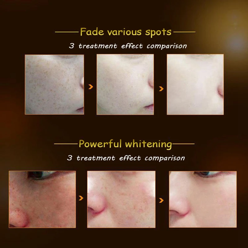 Оригинальный жидкий крем для ухода за кожей от прыщей и 10 мл | Красота здоровье