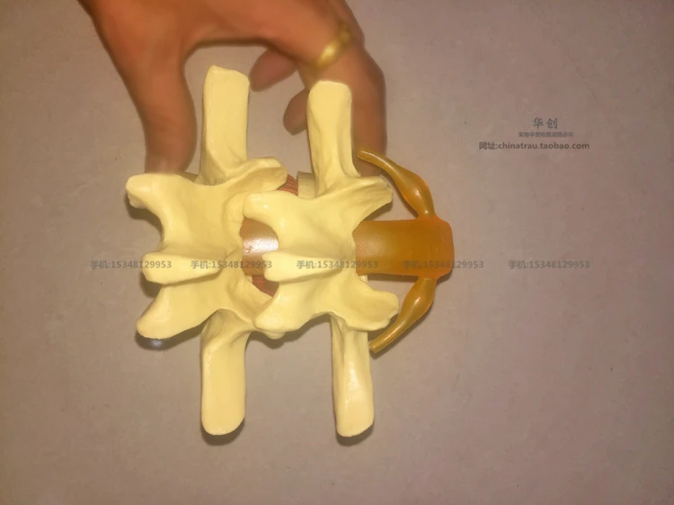 Медицинский Поясничный позвонка модель поражения нормальном состоянии CMAM VERTEBRA12