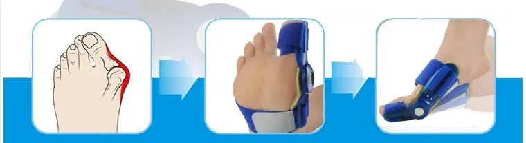 Ортопедические подтяжки для большого пальца при вальгусной деформации | Красота