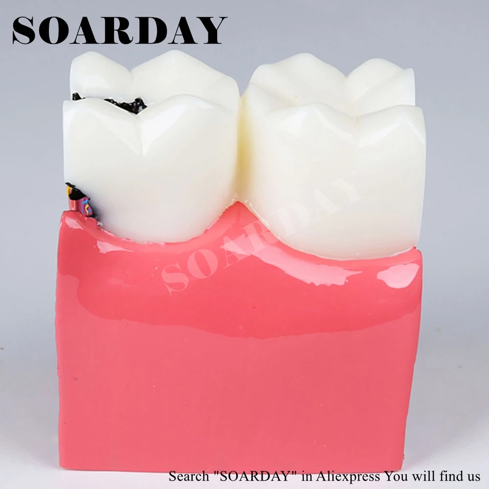 

SOARDAY Six times Caries Comparison Model Teaching Demonstration Communication Oral Model Pathological Dental Model