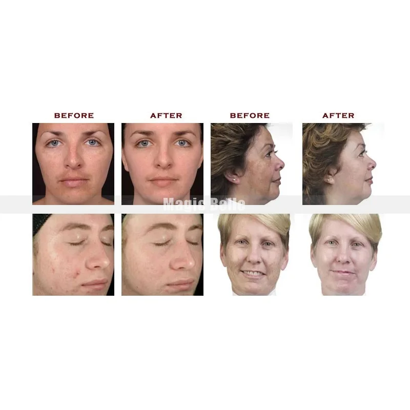 Самая популярная Алмазная дермабразия Ремонт клеток кожи пилинг hydrafacial дермабразия машина из Кореи