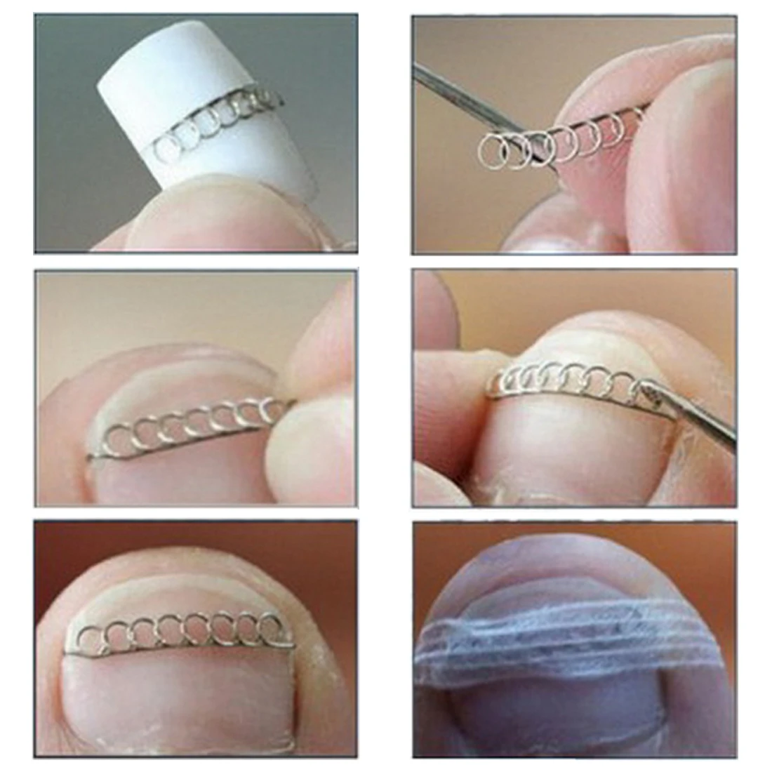 Вросших ногтей ног Pedicure коррекции 6 шт./кор. фиксаж провода средства ухода за кожей стоп пироги, забота о ногах инструменты акроникс onyxis ортопедические восстановить паронихии