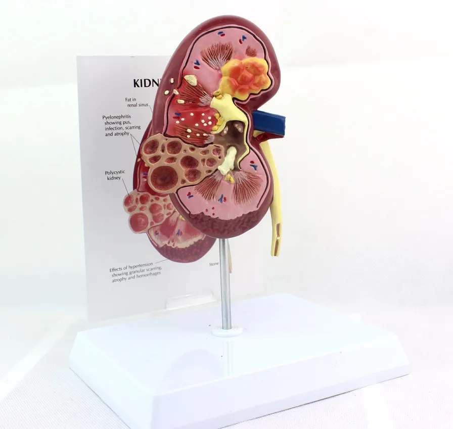 Почечные камни модель болезни Урология почек Nephron почечный гломерулус анатомическая модель почечная анатомическая модель медицинская учебная поставка