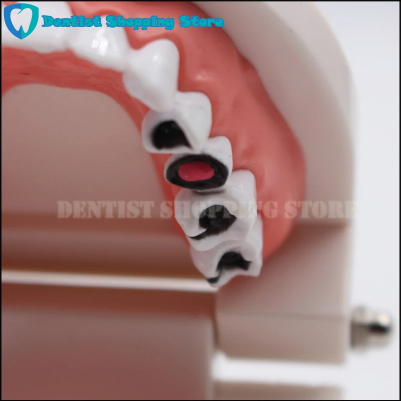 

Dental Study Teaching Teeth Model Caries Tooth Care Education Dentist Equipment Oral Care Tool