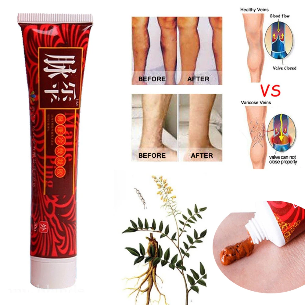 Крем для лечения варикоза вен мазь васкулит флебит Спайдермен боль варикоз