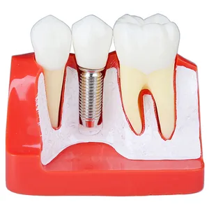 4-кратная модель зубов, анализ зубных имплантатов, корончатый мост, демонстрация Стоматологическая модель зубов, инструменты для стоматологии, модель для исследований