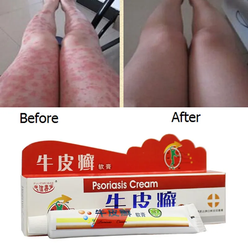25 г крем от псориаза китайская мазь медицина|Пластыри терапевтические| |
