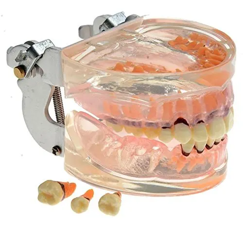 Образовательная модель пародонтоза для обучения зубным зубам