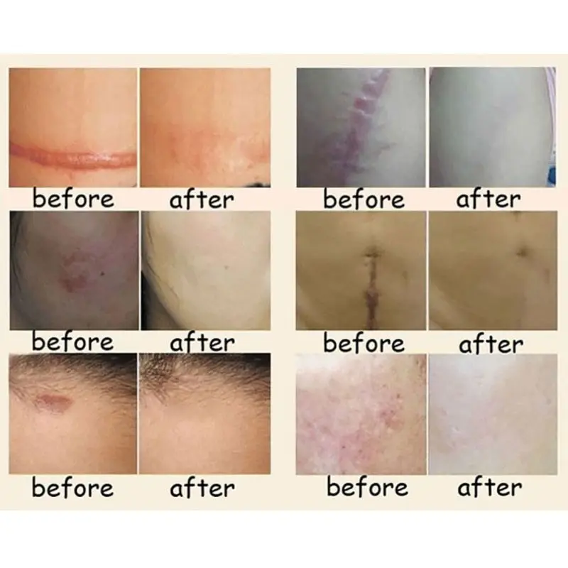 2018 удаление шрамового крема акне точек корректор пигментации мазь|Пластыри