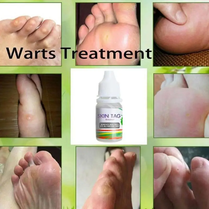 10 мл Крем для лечения бородавки кожи средство удаления мозолей ног подошвенные