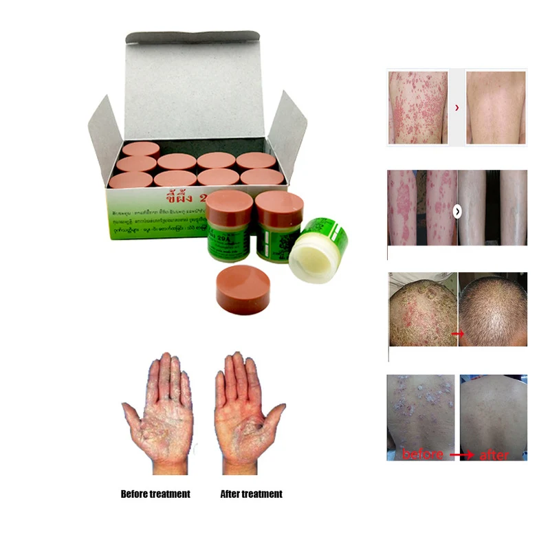 12 шт. 29A Натуральный Крем действительно хорошо работает для псориаси Eczma уход за кожей