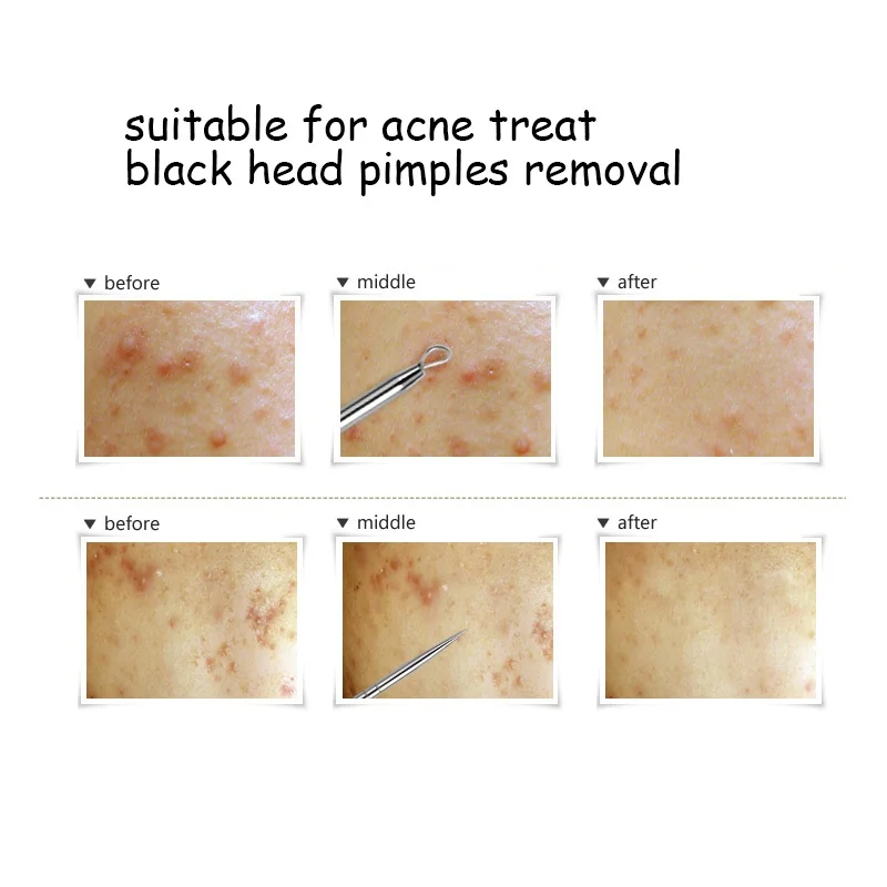 Silver Stainless Steel Blackhead Remover point noir Needle Acne Black Head Pimples sefw | Красота и здоровье