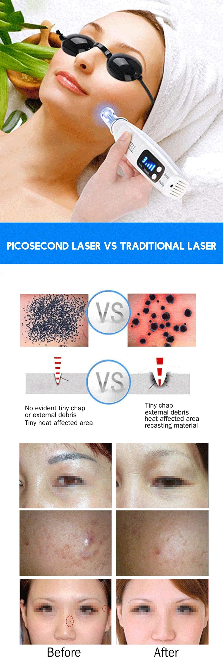Picosecond лазерная ручка Темный инструмент для удаления пятен терапия пигмент тату шрам моль веснушки удаление Лазерная пикосекундная ручка