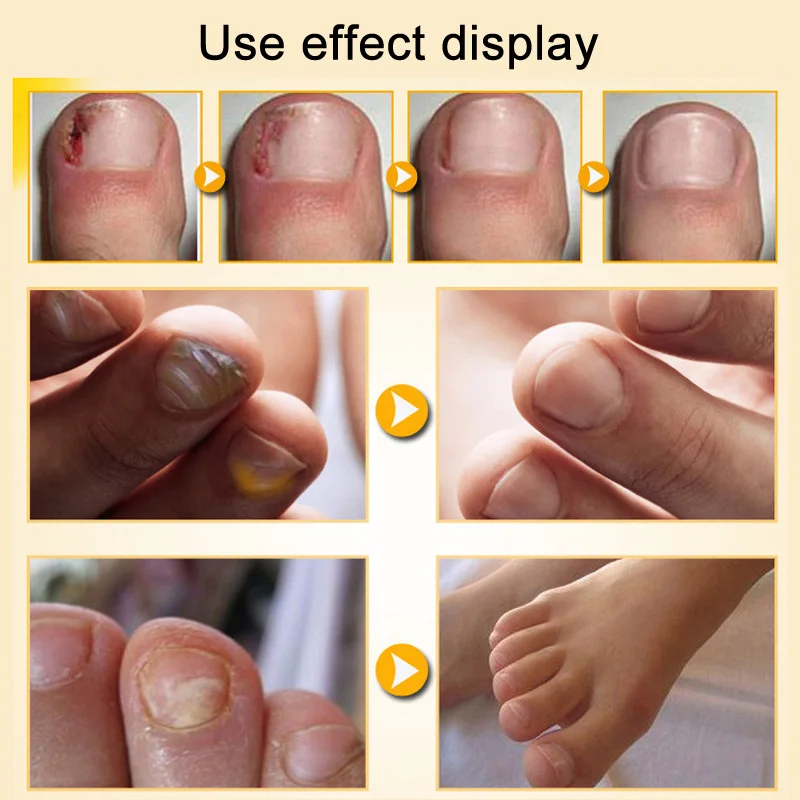 Жидкость для лечения Ногтей от грибков 30 мл|Средства ухода за ногтями| |