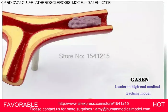 Анатомическая сосудистая атеросклерозная патология человека медицинский орган