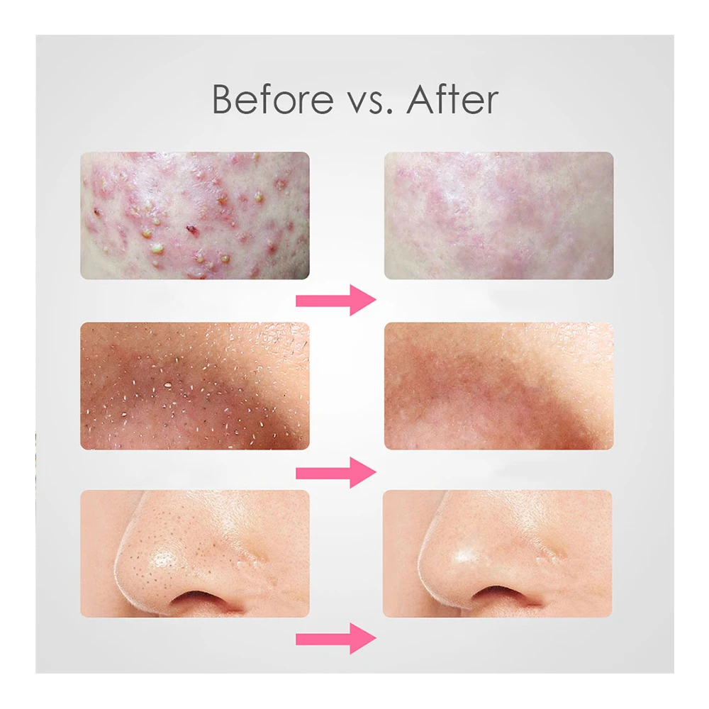 7 шт. пинцет для удаления черных точек|Устройство ухода за кожей лица| |