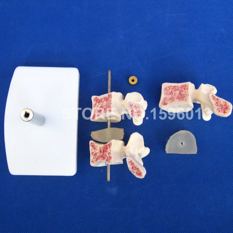 Горячая продвинутая модель остеопороза позвоночника повреждения в модели