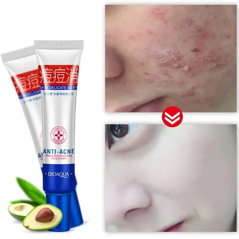 Крем для лечения акне BIOAQUA 30 г Anyi acne идеальный уход за кожей лечение увлажнение