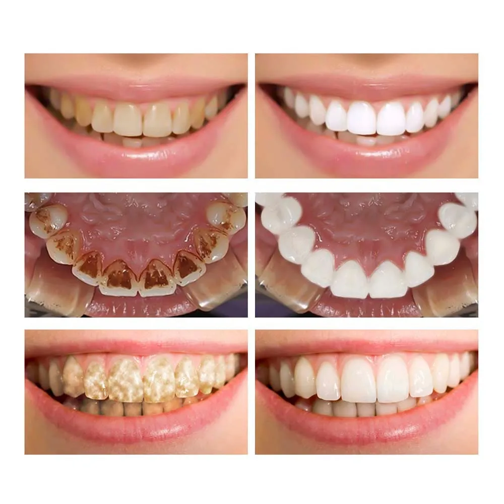 LANBENA Teeth Whitening Petrol Powder Cleaning Serum Removes Plaque Blemishes Dental Tools Face Care | Красота и здоровье