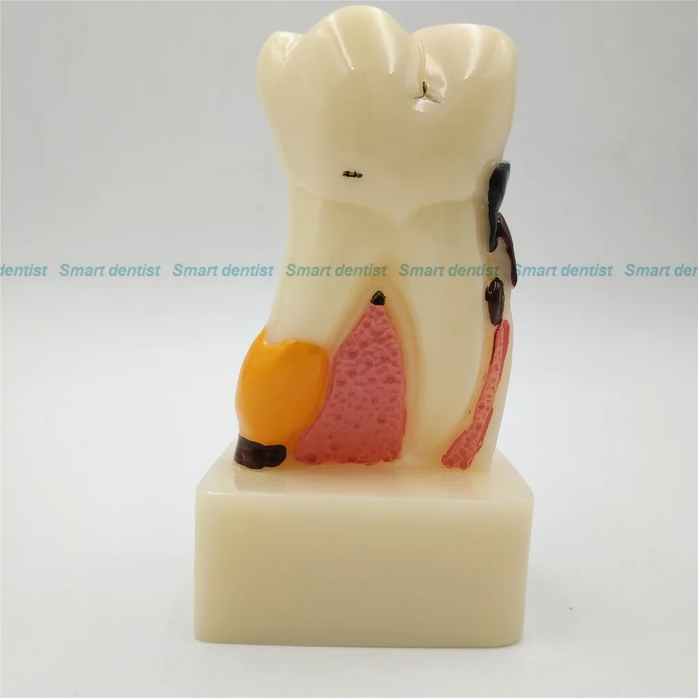 Стоматологическая модель, анатомическая модель, модель зубов, демонстрация кариеса, десен от AliExpress RU&CIS NEW