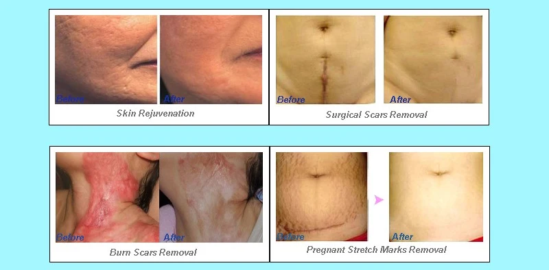 newest fractional co2 laser machine for Vagina Tighting Pigment Removal face lifting Beauty Equipment CO2 Fractional Laser