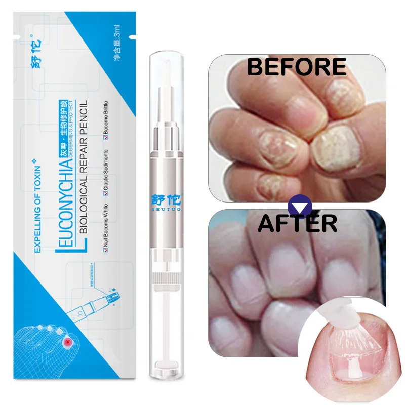 Good Result Nail Treatment Pen Onychomycosis Paronychia Anti Fungal Infection Chinese Herbal Toe Fungus | Красота и здоровье