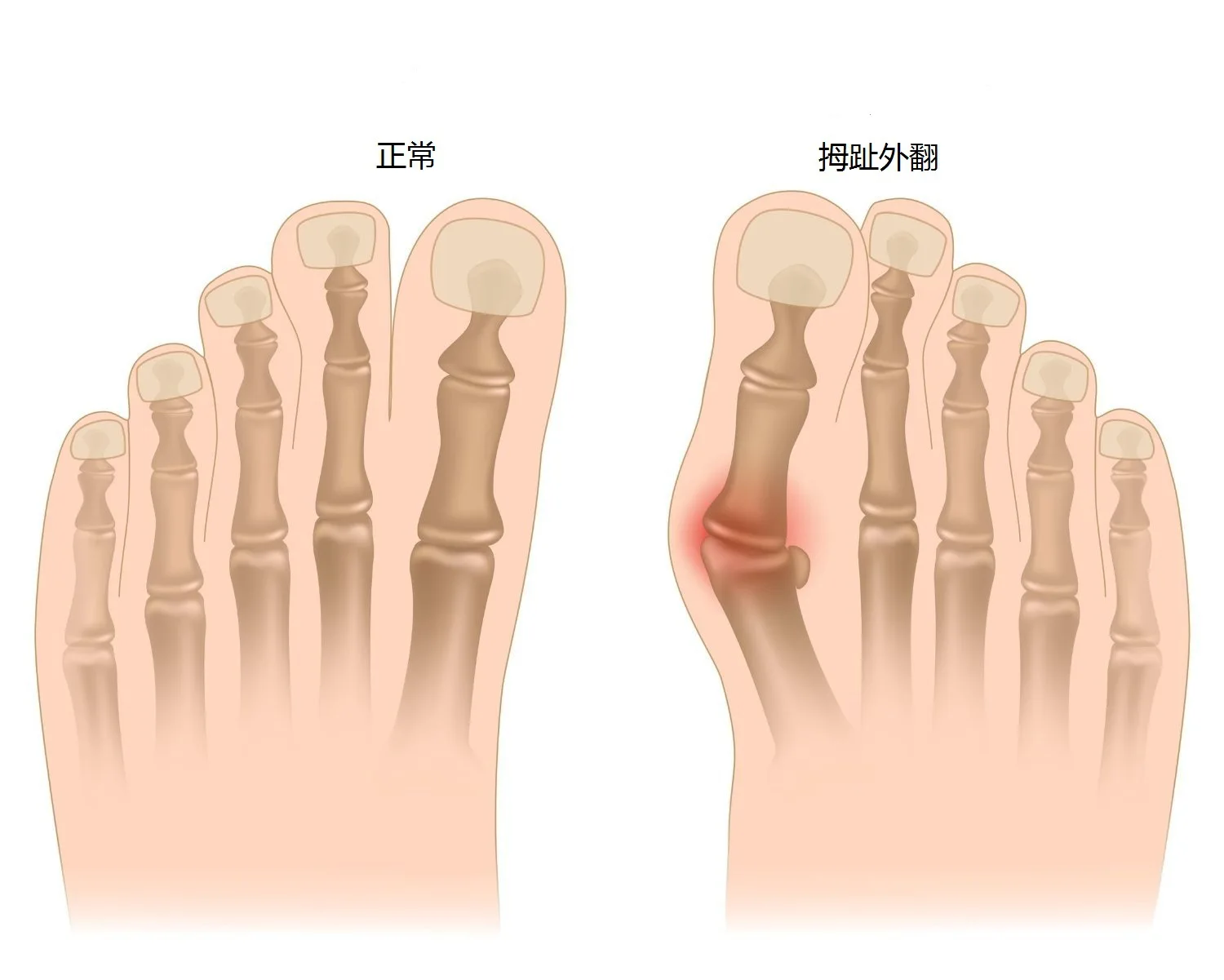 2 шт. корректор Bunion для ног Коррекция кости большого пальца коррекция педикюра устройство для устранения вальгусной деформации первого пальца стопы разделитель пальцев ортопедическая прокладка