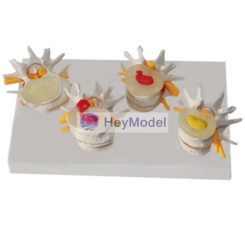 Четырехступенчатая поясничная модель позвоночника HeyModel костные шпоры