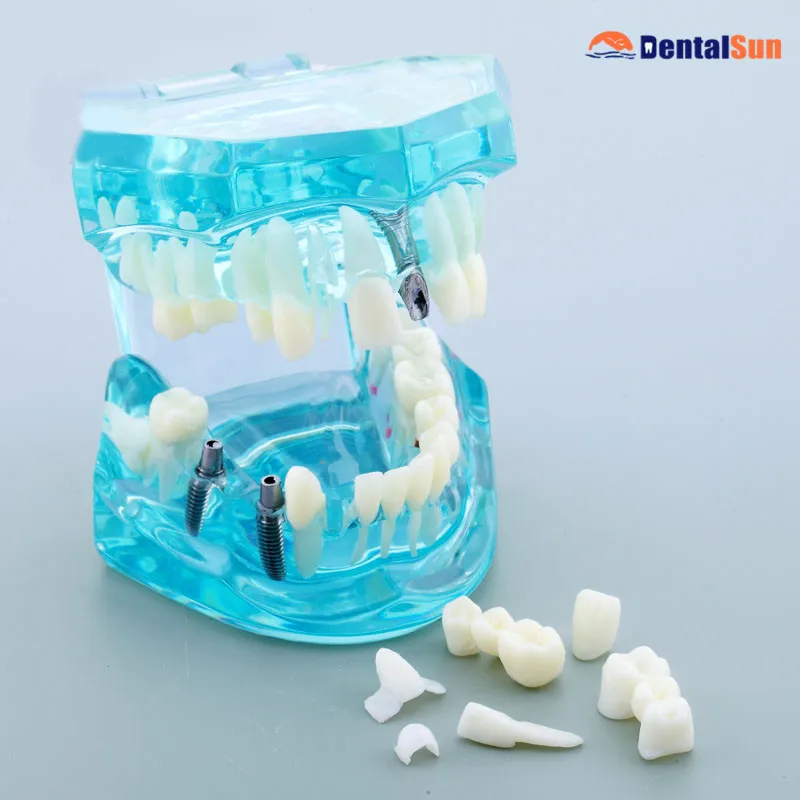 

Dental Implant and Restoration Model/Dental Implant Repair Teeth Model M2001