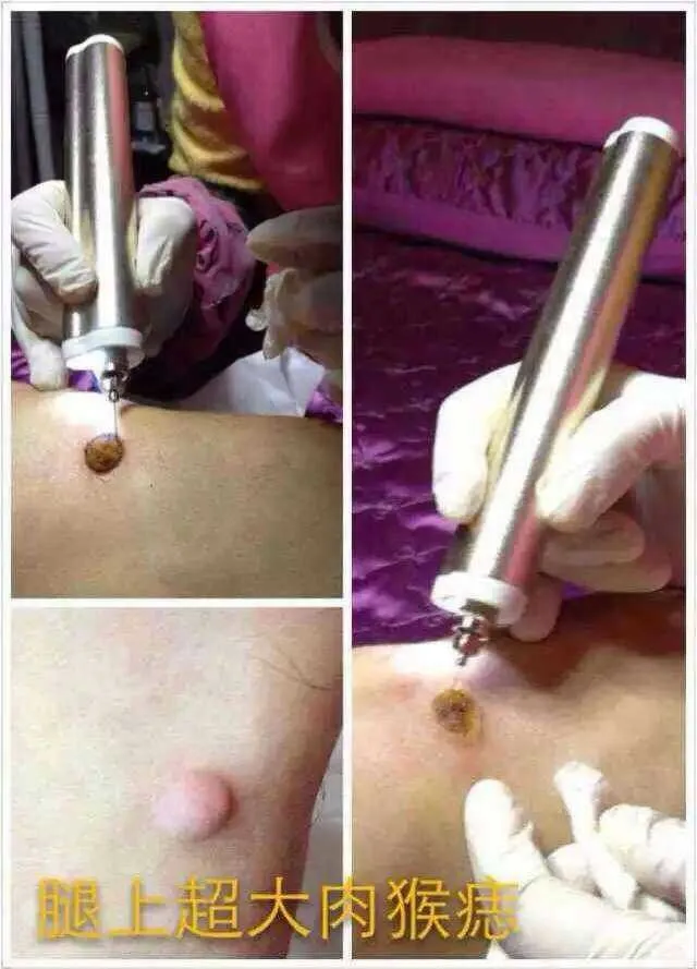 Новая микро плазма красота моль удаление развертки точечная ручка Lastest